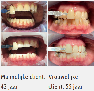 Afbeelding: voor en na foto's van tanden bleken in Assen