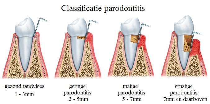 Crimineel transfusie Vegen Wat is parodontitis? - Tandartsenpraktijk Oranjebuurt Assen